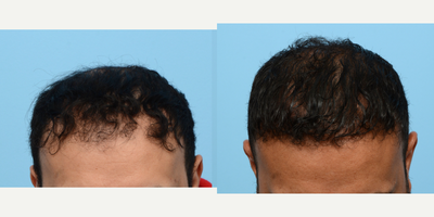 35-44 year old man treated with FUE Hair Transplant, Hair Transplant, Hair Loss Treatment, PRP for Hair Loss, Low-Level Laser Th - This patient wanted to restore his hairline and add density to the crown area. Dr. Wise performed an FUE hair transplant with 3,035 grafts and one treatment of PRP. 6 months post-op the patient is thrilled with his results and will continue to see growth up to the 1 year mark.