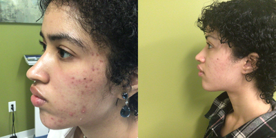 18-24 year old woman treated with Vampire Facelift - Post Acne scarring treated with PRP Facial