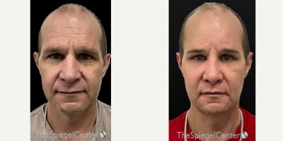 35-44 year old transgender woman treated with Transgender Facial Feminization Surgery - 35-44 year old transgender woman treated with Transgender Facial Feminization Surgery