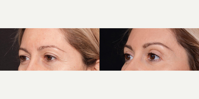 Woman treated with Brow Lift - Looking for a way to do away with sagging brows and replace it with a smoother, wrinkle-free forehead? Its time to ditch droopy eyebrows! A Brow Lift is a fantastic solution to refresh your face for those who are looking for results that last longer than Botox. As a double board certified facial plastic surgeon, I take pride in utilizing the latest techniques to allow this procedure to be completed in a relatively short period of time on an outpatient basis. Many patients fear that a brow lift will leave them permanently surprised or unnaturally wide eyed, however from these gorgeous results above it is clear to see that this procedure leaves you looking younger and subtly refreshed!