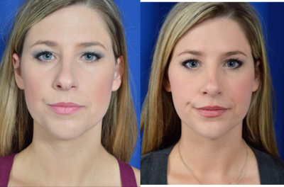 25-34 year old woman treated with Rhinoplasty - Rhinoplasty performed&nbsp;to straighten the nose and to address the shape of the nasal bridge.