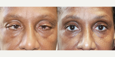 57 year old woman treated with Bi-Liateral Ptosis Surgery giving the eyes a more youthful appearance - Ptosis surgeryin to correct your upper eyelid droopiness, improving vision and improving overall appearance.