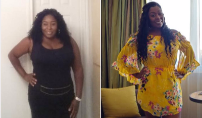 25-34 year old woman treated with Sleeve Gastrectomy - Weight loss progress since October 2016