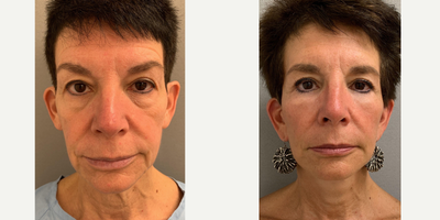 55-64 year old woman treated with Mini Lift - 63 y/o woman underwent lower facelift and upper and lower eyelid surgery (blepharoplasty) in our office operating suite under sedation.