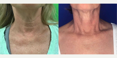 55-64 year old woman treated with Skin Rejuvenation - Forever Young BBL by Sciton, 5 treatments One month apart total in five months