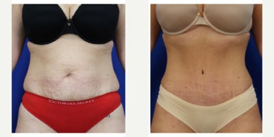 25-34 year old woman treated with Drainless Tummy Tuck, Tummy Tuck - 3 months post drainless abdominoplasty to address muscle separation, skin laxity and contours.