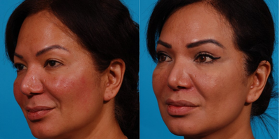 45-54 year old woman treated with Eyelid Surgery and Lip Lift Surgery - Lovely woman consulted with Dr. Olson about her concerns with her upper eyelids and elongated upper lip.  Stated she is being told repeatedly how tired she looks! Requested Dr. Olson's recommendations to freshen her face.  Dr. Olson recommended a lip lift and upper blepharoplasty which could be performed in the office under a local anesthetic.  This is her result 2 weeks after her surgery.