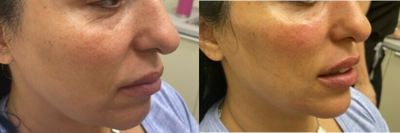 45-54 year old woman treated with Restylane Contour - Liquid facelift, and facial balancing.