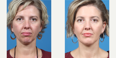 35-44 year old woman treated with Chin Implant, Neck Lift - 35-44 year old woman treated with Chin Implant, Neck Lift