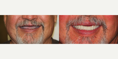 All-on-4 Dental Implants - All-on-4 Dental Implants