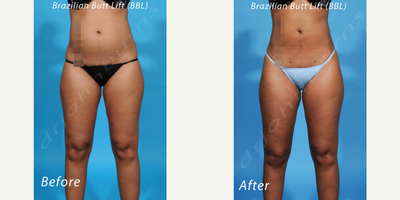 35-44 year old woman treated with Laser Liposuction - Laser liposuction as part of a Brazilian Butt Lift (BBL) procedure