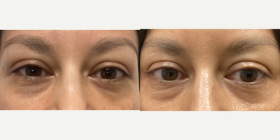 Woman treated with Morpheus8, Forma - 2 month post Morpheus and forma