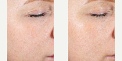Skinbetter Science - AlphaRet Exfoliating Peel Pads.Photo provided courtesy of Skinbetter Science.
