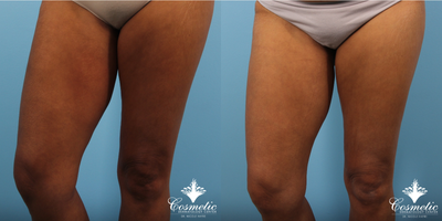 35-44 year old woman treated with Emtone - Improved appearance of inner thigh gap after 4 treatments of Emtone