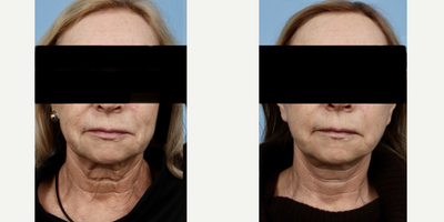 75 and up year old woman treated with Deep Plane Facelift - Deep Plane Facelift