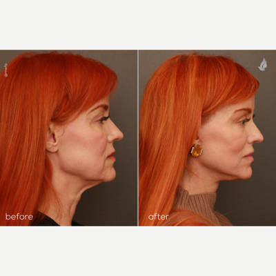 Deep plane facelift and full face CO2 laser - This patient is 2 months out from a deep plane facelift and full face CO2 laser