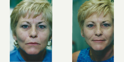 Silikon 1000 to smoker's lines - Patient wanted to soften the lines on the upper lip, typically seen in smokers. Two injections of Silikon 1000 were done to achieve this result.&nbsp;