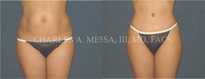 Woman treated with Mommy Makeover - Woman treated with Mommy Makeover
