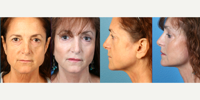 45-54 year old woman with cheek implants/augmentation - Cheek implants