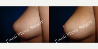 18-24 year old woman treated with Nipple Surgery - This 19 year old patient, was interested in inverted nipple repair. Patient is 1 month post op inverted nipple repair.