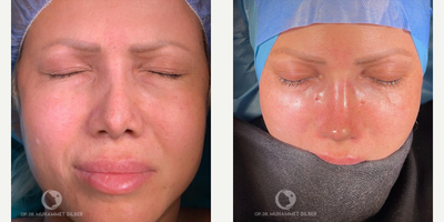 35-44 year old woman treated with Revision Rhinoplasty - female patient come to me to have revision Rhinoplasty to fix crooked and droopy, ridge receding and wide nose tip. she was unhappy with the previous doctor's work.