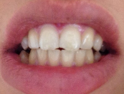 Best options for a chipped front tooth