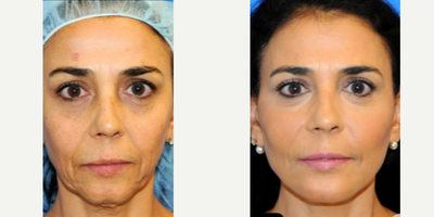 Woman treated with Nonsurgical Facelift - Discover the Revolutionary Y LIFT with Dr. Tehrani.Treatment Overview The Y LIFT is a non-surgical facial rejuvenation procedure that uses a specialized blunt titanium instrument to lift and support underlying facial structures.This technique creates a foundation for youthful contours and involves injecting FDA-approved hyaluronic acid fillers to maintain the elevated position of the muscles. An APS board-certified plastic surgeon and expert injector ensures the appropriate filler selection, minimizing allergic reactions and side effects. Y LIFT Results typically last 2-4 years.
