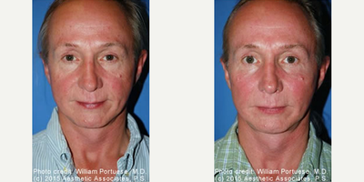 Man treated with Cheek Implants - Man treated with Cheek Implants