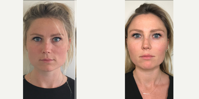Botox - before and after facial slimming using botox in the TMJ muscle