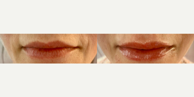 Woman treated with Restylane Silk - When building volume in the lips, gradual is better. This patient had 2mLs over 1 year. Its also important to maintain or build the Cupids bow and philtral columns for a beautifully sculpted lip.
