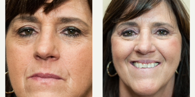 35-44 year old woman treated with Eyelid Surgery - Theresa wanted to join her friends and was excited to have an upper eyelid blepharoplasty performed to help her look more rested.