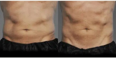 Man treated with CoolTone - Man treated with CoolTone