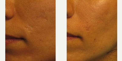30 year old woman treated with Bellafill - This is a 30 year old female with a history of a cold sore scar. This star shaped depressed scar was treated with Bellafill. This is after her first treatment which required less than one syringe. In addition, another scar to the upper right was also injected. Note the after photo with the filled in scar resulting in a smoother appearance. Patient went on to have a second treatment for further improvement to the scar.