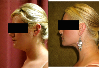 liposuction of neck & jaw line for women - 
	liposuction of neck &amp; jaw line for women in Los Angeles
