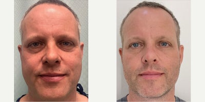 55-64 year old man treated with Eyelid Surgery - Lower blepharoplasty, fat transposition, skin pinch + TCA butterfly peel.