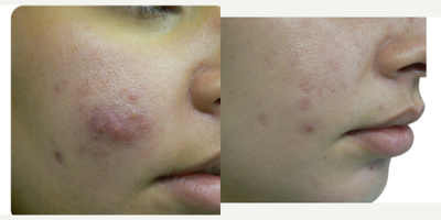 35-44 year old woman treated with Laser Resurfacing, CO2 Laser, YAG Laser, Fractional Laser, UltraPulse CO2 Laser, Facial - LASER ACNE TREATMENT