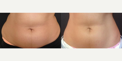 SculpSure - Woman treated with SculpSure