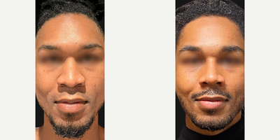 Man treated with African American Rhinoplasty - Performers naturally want to look their best! Our talented patient from Alabama, USA, is a professional dancer and singer who desired a more refined profile, with a defined bridge and radix.We performed an open rhinoplasty with Piezo, using diced cartilage with fascia to augment the dorsum and achieve a balanced, harmonious nose.Now, just 3 months post-op, hes enjoying sharper, yet natural-looking contours.