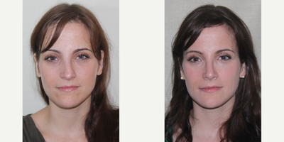 25-34 year old woman treated with Sinus Surgery - Female patient 3 months out from Vestibular Stenosis, Turbinate Reduction, Septoplasty procedure.