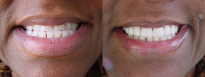 Lumineers - This patient had a severe underbite. Lumineers solved her problem within 2 weeks with no surgery, no injections, no pain. 