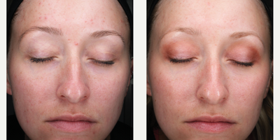 Skinbetter Science - AlphaRet Professional Peel System.Photo provided courtesy of Skinbetter Science.