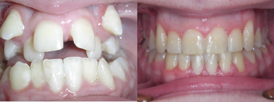Damon Braces - 
	Patient had severe crowding and narrow arches. Damon Braces and RPE were used to widen arches and straightened teeth.
