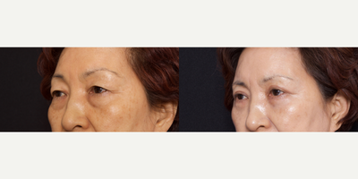 Woman treated with Double Eyelid Surgery - Woman treated with Double Eyelid Surgery