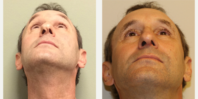 45-54 year old man treated with Rhinoplasty - This gentleman had very twisted and distorted lower lateral cartilages. It is difficult to produce perfect symmetry in this situation, particularly given the fact that he wanted his nose to look natural. With a combination of limited cartilage excision, suture reconstruction, and a columellar strut, he had significant improvement and was pleased.