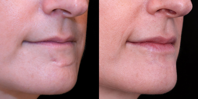 25-34 year old female scar removal with excision followed by dermabrasion and DeepFX laser resurfacing, - Excision followed by dermabrasion and DeepFX laser resurfacing, and vascular laser treatments.
