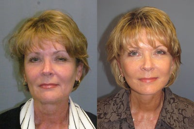 Liposuction, LiteLift on 58-year-old Woman - This 58-year-old woman had a LiteLift&trade; and Liposuction procedure. Notice post-op &nbsp;her nasolabial fold. Liposuction under the chin adds contour and defines the jaw line.