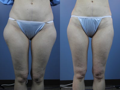 Laser Lipo : Saddle Bags  - LLP: Saddle Bags