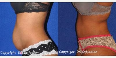 Tummy Tuck - Tummy Tuck