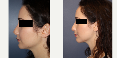 18-24 year old woman treated with Revision Rhinoplasty - 24 year old female  undergoing rhinoplasty