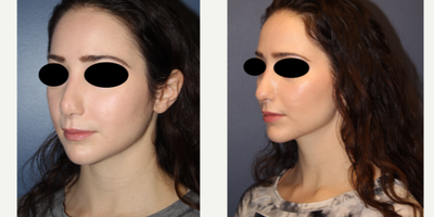18-24 year old woman treated with Revision Rhinoplasty - 24 year old female  undergoing rhinoplasty
